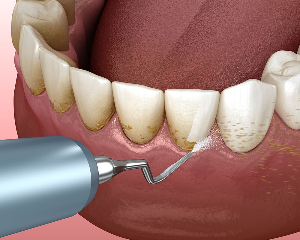 periodoncia dental
